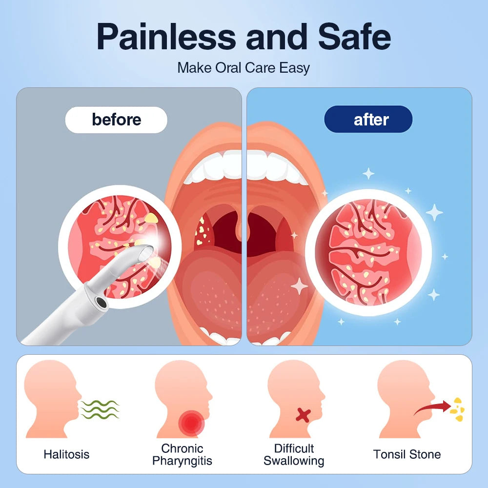 Hailicare Camera Tonsil Stone Remover With LED Light And Suction